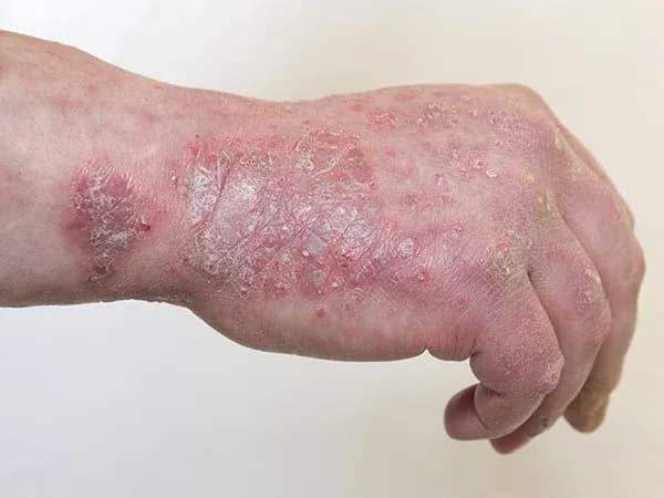 main et poignet avec plaques rouges et peau squameuse liées à une dermatose